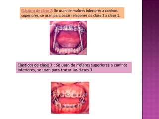 Elásticos de clase 2: Se usan de molares inferiores a caninos
  superiores, se usan para pasar relaciones de clase 2 a clase 1.




Elásticos de clase 3 : Se usan de molares superiores a caninos
inferiores, se usan para tratar las clases 3
 