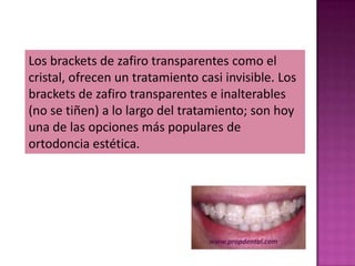 Los brackets de zafiro transparentes como el
cristal, ofrecen un tratamiento casi invisible. Los
brackets de zafiro transparentes e inalterables
(no se tiñen) a lo largo del tratamiento; son hoy
una de las opciones más populares de
ortodoncia estética.
 