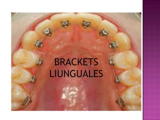 BRACKETS
LIUNGUALES
 