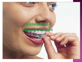 Alineadores
transparentes
 