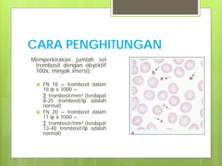CARA PENGHITUNGAN
Memperkirakan jumlah sel
trombosit dengan obyektif
100x, minyak imersi):




FN 18 = trombosit dalam
18 lp x 1000 =
∑ trombosit/mm3 (terdapat
8-25 trombosit/lp adalah
normal)
FN 20 = trombosit dalam
11 lp x 1000 =
∑ trombosit/mm3 (terdapat
13-40 trombosit/lp adalah
normal)

 