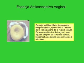 Esponja Anticonceptiva Vaginal Esponja sintètica blana, impregnada d'espermaticida, que es fica a l'interior de la vagina abans de la relació sexual. És prou semblant al diafragma i, com aquest, després de la relació sexual, l'esponja ha de deixar-se en el lloc de 6 a 8 hores.  