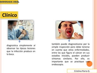 Cristina Parra G.
también puede diagnosticarse por la
simple inspección pero debe tenerse
en cuenta que otras enfermedades,
entre las que figura el cáncer en sus
estadios iniciales, pueden producir
síntomas similares. Por ello, es
importante que se practique una
endoscopia.
Clínico
diagnostica simplemente al
observar las típicas lesiones
que la infección produce en
la boca.
 