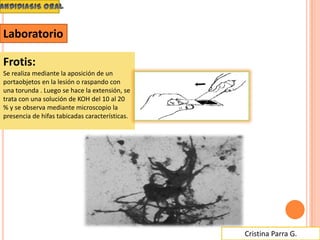 Cristina Parra G.
Frotis:
Se realiza mediante la aposición de un
portaobjetos en la lesión o raspando con
una torunda . Luego se hace la extensión, se
trata con una solución de KOH del 10 al 20
% y se observa mediante microscopio la
presencia de hifas tabicadas características.
Laboratorio
 