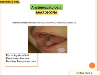 Cristina Parra G.
Anatomopatología
MACROSCOPÌA
•Patrones variables: Pseudomembranosa, hipertrófica, eritematosa, atrófica, etc.
Forma Aguda Infantil
Pseudomembranosa
Manchas Blancas en boca
 