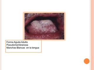 Forma Aguda Adulto
Pseudomembranosa
Manchas Blancas en la lengua
 