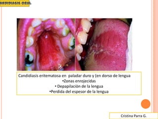 Cristina Parra G.
Candidiasis eritematosa en paladar duro y (en dorso de lengua
•Zonas enrojecidas
• Depapilaciòn de la lengua
•Perdida del espesor de la lengua
 