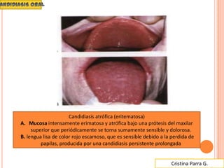 Cristina Parra G.
Candidiasis atrófica (eritematosa)
A. Mucosa intensamente erimatosa y atrófica bajo una prótesis del maxilar
superior que periódicamente se torna sumamente sensible y dolorosa.
B. lengua lisa de color rojo escamoso, que es sensible debido a la perdida de
papilas, producida por una candidiasis persistente prolongada
 