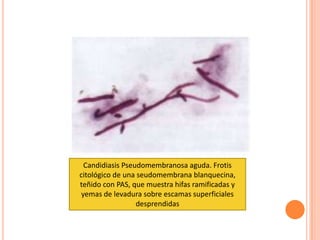 Candidiasis Pseudomembranosa aguda. Frotis
citológico de una seudomembrana blanquecina,
teñido con PAS, que muestra hifas ramificadas y
yemas de levadura sobre escamas superficiales
desprendidas
 