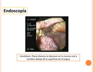 Endoscopía
Candidiasis. Placas blancas se observan en la mucosa oral y
también debajo de la superficie de la lengua
 