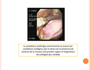 La candidiasis orofarígea comúnmente se asocia con
candidiasis esofágica; por lo tanto con la presencia de
lesiones de la mucosa oral pueden sugerir el diagnóstico
de esofagitis por cándida
 