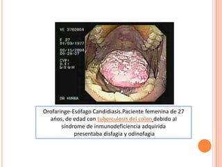 Orofaringe-Esófago Candidiasis.Paciente femenina de 27
aoos, de edad con tuberculosis del colon debido al
síndrome de inmunodeficiencia adquirida
presentaba disfagia y odinofagia
 