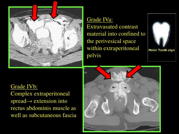 Tutorial bladder trauma