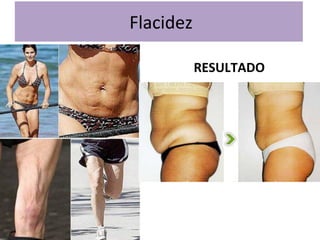 Flacidez
RESULTADO

 