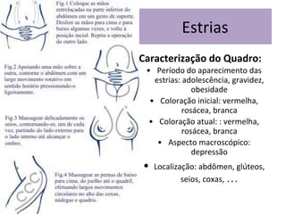 Estrias
Caracterização do Quadro:
• Período do aparecimento das
estrias: adolescência, gravidez,
obesidade
• Coloração inicial: vermelha,
rosácea, branca
• Coloração atual: : vermelha,
rosácea, branca
• Aspecto macroscópico:
depressão

•

Localização: abdômen, glúteos,
seios, coxas, …

 