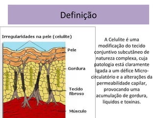 Definição
A Celulite é uma
modificação do tecido
conjuntivo subcutâneo de
natureza complexa, cuja
patologia está claramente
ligada a um défice Microcirculatório e a alterações da
permeabilidade capilar,
provocando uma
acumulação de gordura,
líquidos e toxinas.

 