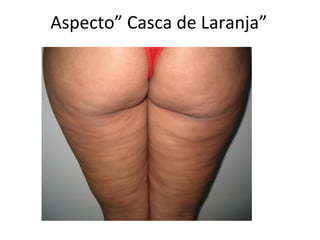 Aspecto” Casca de Laranja”

 