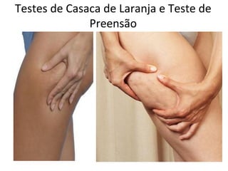 Testes de Casaca de Laranja e Teste de
Preensão

 