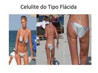 Celulite do Tipo Flácida

 