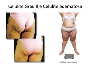 Celulite Grau II e Celulite edematosa

 