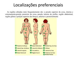 Localizações preferenciais
As regiões afetadas mais frequentemente são: a porção superior da coxa, interna e
externamente,porção posterior da coxa, porção interna do joelho, região abdominal,
região glútea e porção superior dos braços, anterior e posteriormente.

 