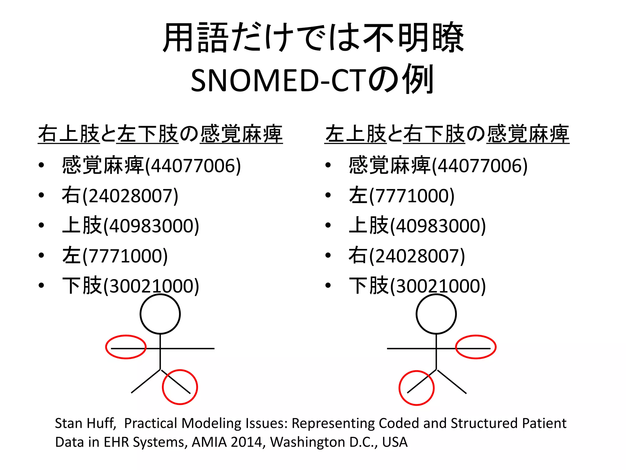 用語だけでは不明瞭
SNOMED-CTの例
右上肢と左下肢の感覚麻痺
• 感覚麻痺(44077006)
• 右(24028007)
• 上肢(40983000)
• 左(7771000)
• 下肢(30021000)
左上肢と右下肢の感覚麻痺
• 感覚麻痺(44077006)
• 左(7771000)
• 上肢(40983000)
• 右(24028007)
• 下肢(30021000)
Stan Huff, Practical Modeling Issues: Representing Coded and Structured Patient
Data in EHR Systems, AMIA 2014, Washington D.C., USA
 
