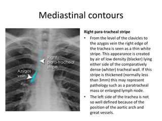 Mediastinal contours
Right para-tracheal stripe
• From the level of the clavicles to
the azygos vein the right edge of
the trachea is seen as a thin white
stripe. This appearance is created
by air of low density (blacker) lying
either side of the comparatively
dense (whiter) tracheal wall. If this
stripe is thickened (normally less
than 3mm) this may represent
pathology such as a paratracheal
mass or enlarged lymph node.
• The left side of the trachea is not
so well defined because of the
position of the aortic arch and
great vessels.
 