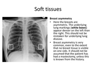 Soft tissues
Breast asymmetry
• Here the breasts are
asymmetric. The underlying
lung markings (white boxes)
appear denser on the left than
the right. This should not be
mistaken for underlying lung
disease.
• Breast asymmetry is very
common, even to the extent
that no breast tissue is visible
on one side. It should not be
assumed that the patient has
had a mastectomy, unless this
is known from the history.
 