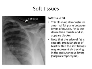 Soft tissues
Soft tissue fat
• This close-up demonstrates
a normal fat plane between
layers of muscle. Fat is less
dense than muscle and so
appears blacker.
• Note that the edge of fat is
smooth. Irregular areas of
black within the soft tissues
may represent air tracking
in the subcutaneous layers
(surgical emphesyma).
 