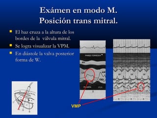 Exámen en modo M.
                Posición trans mitral.
   El haz cruza a la altura de los
    bordes de la válvula mitral.
   Se logra visualizar la VPM.
   En diástole la valva posterior
    forma de W.

                                         VI




                                 VMP
 
