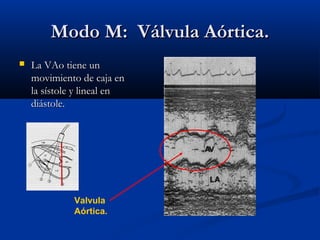 Modo M: Válvula Aórtica.
   La VAo tiene un
    movimiento de caja en
    la sístole y lineal en
    diástole.




              Valvula
              Aórtica.
 
