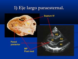 1) Eje largo paraesternal.
                            Septum IV
            VD
                   Ao
    VI

                    AI
                                        VD
                                             Ao
                                  VI
Pared
posterior                                    AI
                 MP
                 Post med
 