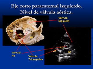 Eje corto paraesternal izquierdo.
    Nivel de válvula aórtica.
                              Válvula
                              Sig pulm


VD
      AD
            AI


                               AD
                         VD         AI
 Valvula
 Ao        Valvula
           Tricuspidea
 
