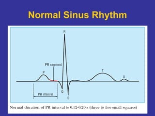 Sinus R1 Tutorial in Basic ECG for Medical Students | PPT