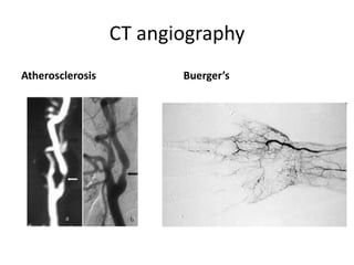 CT angiography
Atherosclerosis Buerger’s
 