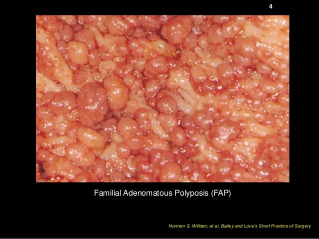 benign tumor on benign tumor of large intestine benign tumor on benign tumor of large intestine