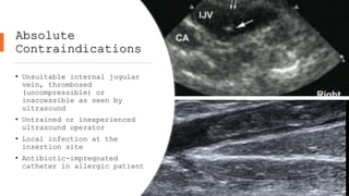 Absolute
Contraindications
• Unsuitable internal jugular
vein, thrombosed
(uncompressible) or
inaccessible as seen by
ultrasound
• Untrained or inexperienced
ultrasound operator
• Local infection at the
insertion site
• Antibiotic-impregnated
catheter in allergic patient
12
 