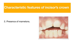 2. Presence of mamelons.
Characteristic features of incisor’s crown
 