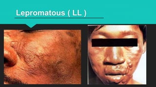morbus hansen ppt