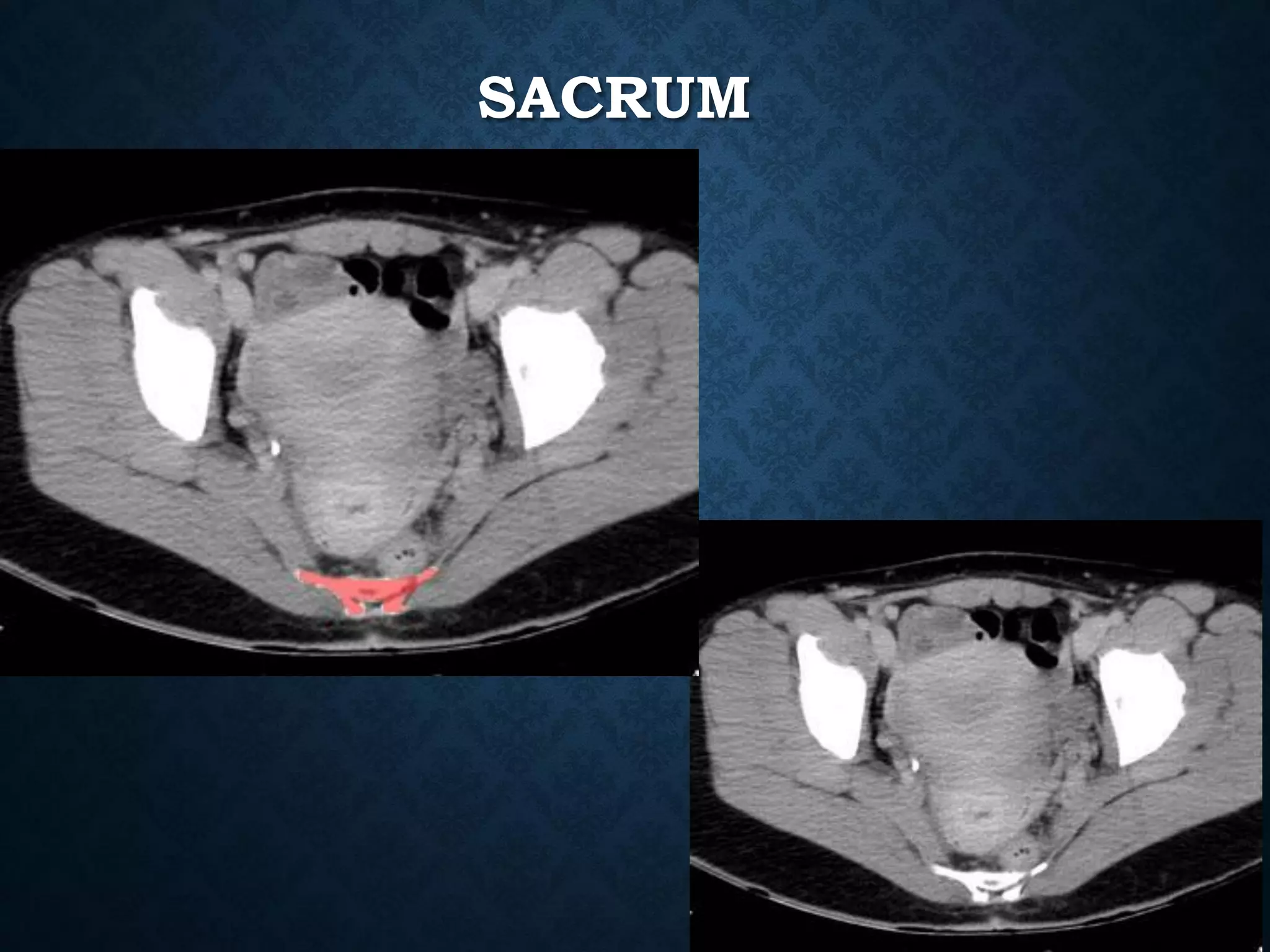 SACRUM
 
