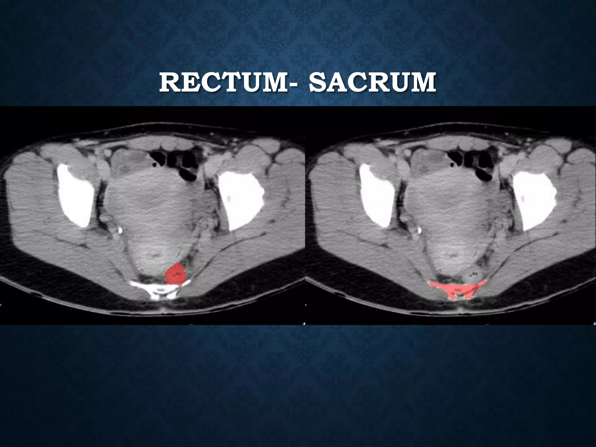 RECTUM- SACRUM
 