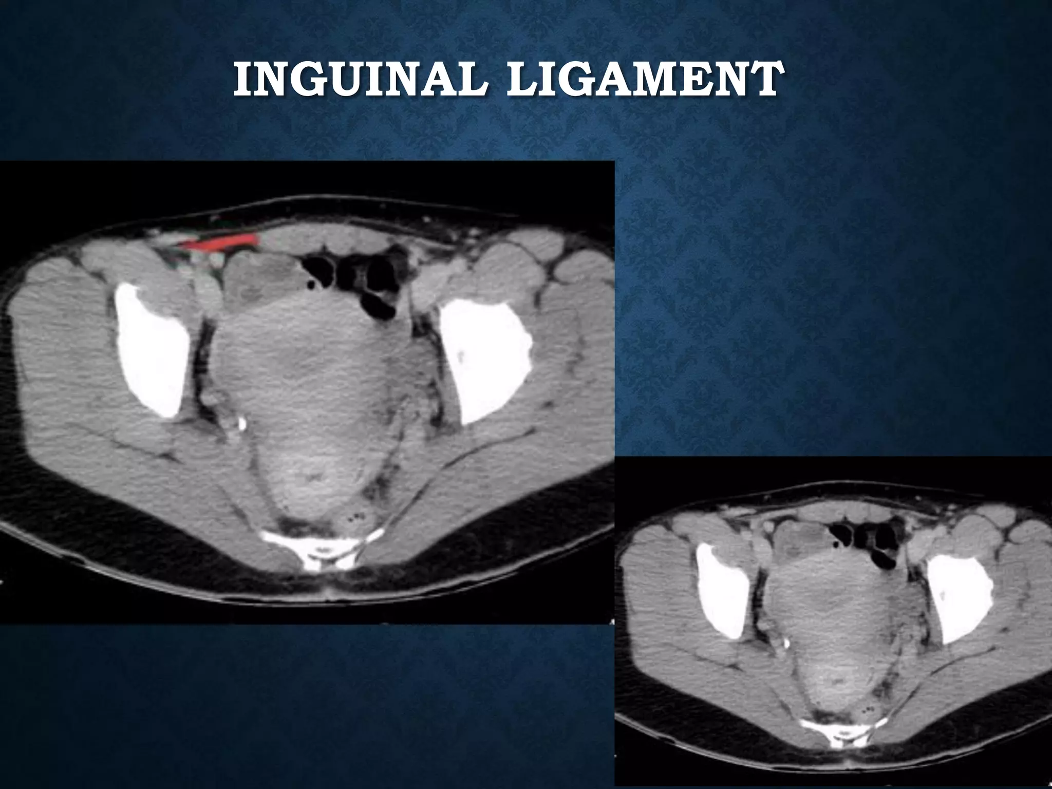 INGUINAL LIGAMENT
 