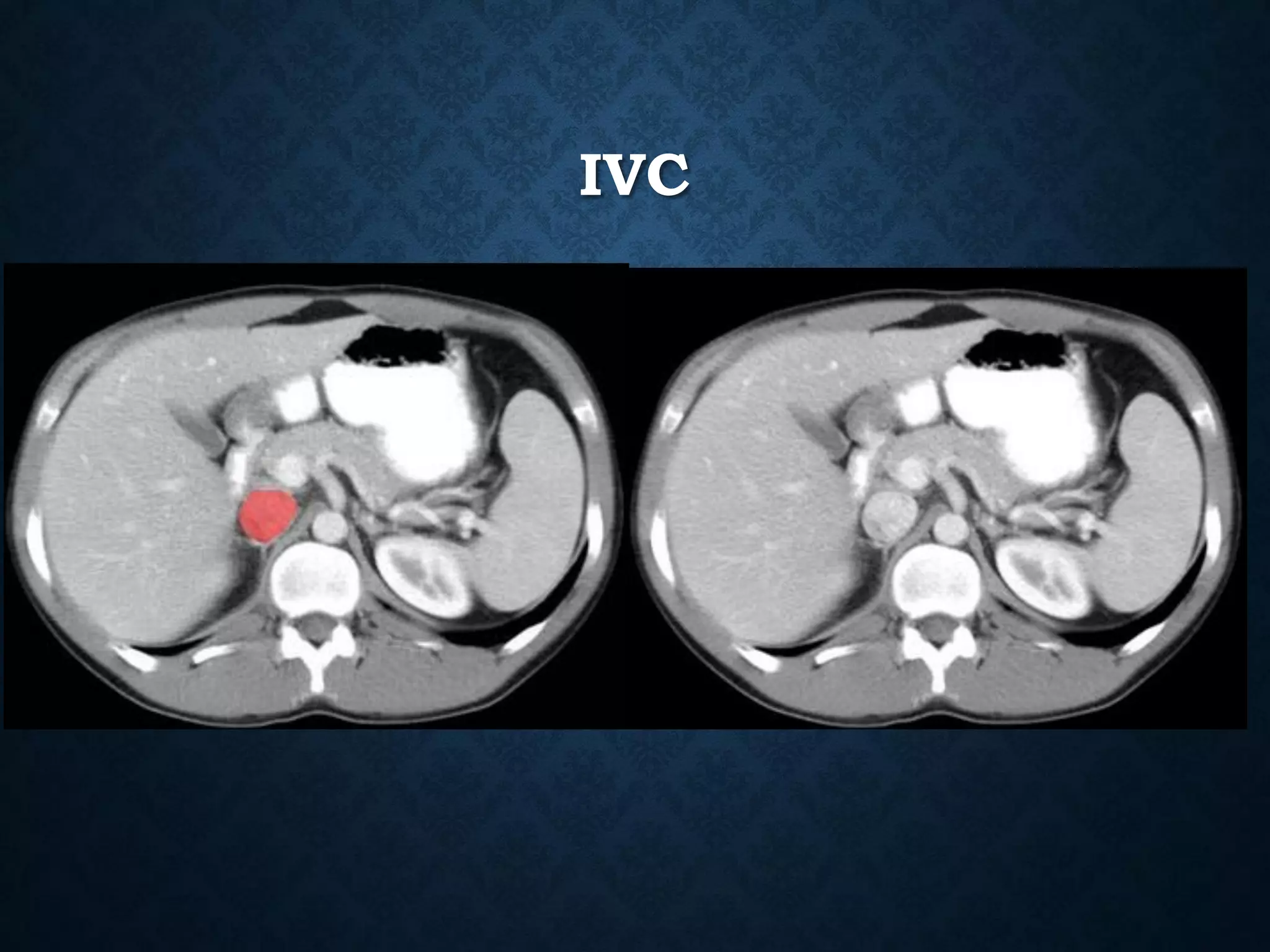 IVC
 