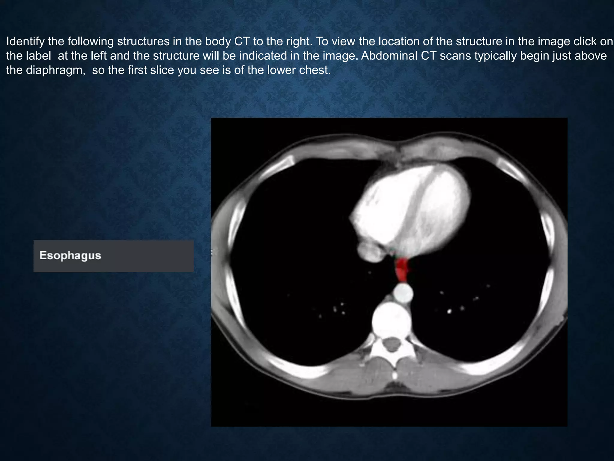 Identify the following structures in the body CT to the right. To view the location of the structure in the image click on
the label at the left and the structure will be indicated in the image. Abdominal CT scans typically begin just above
the diaphragm, so the first slice you see is of the lower chest.
 