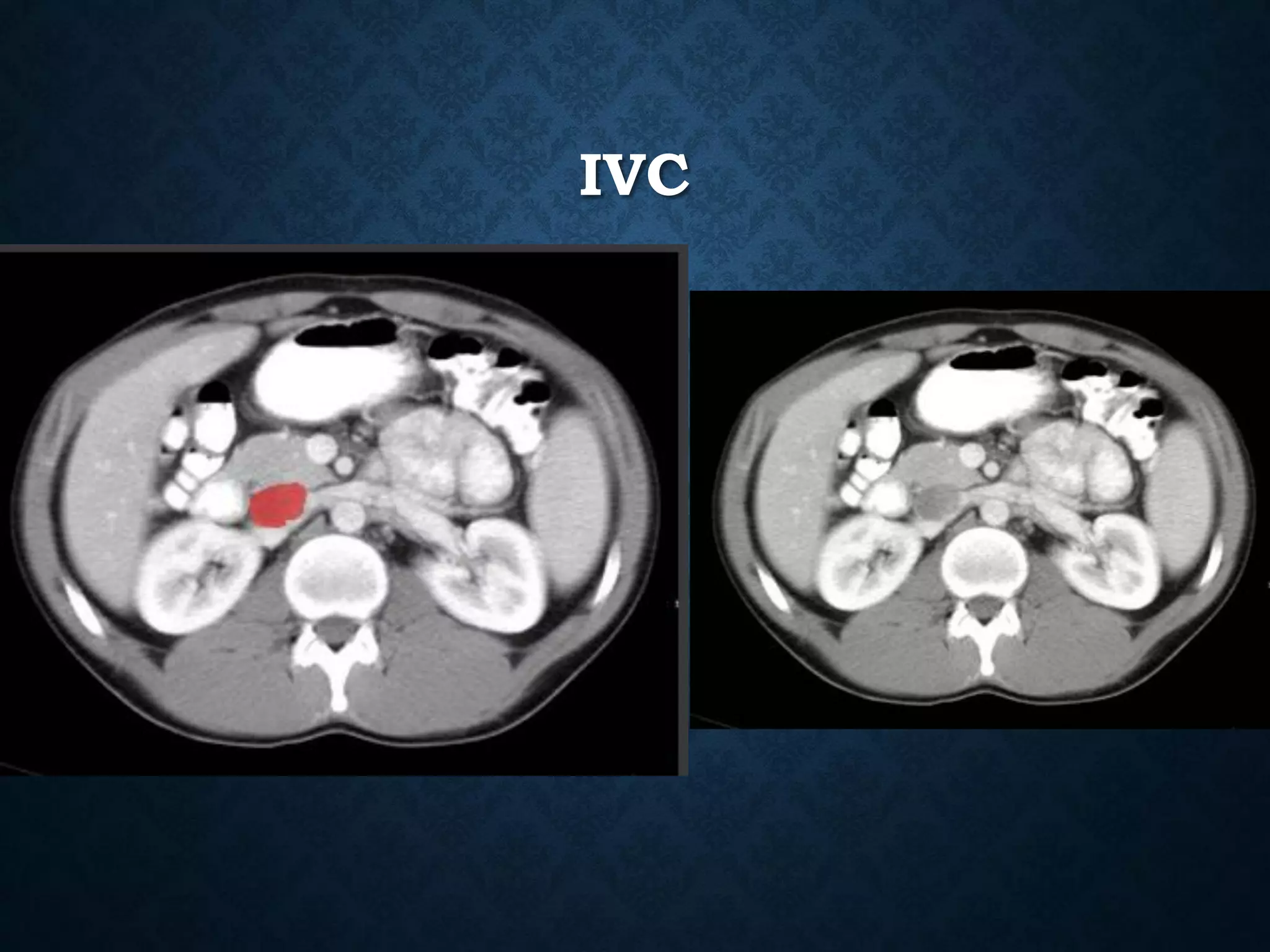 IVC
 
