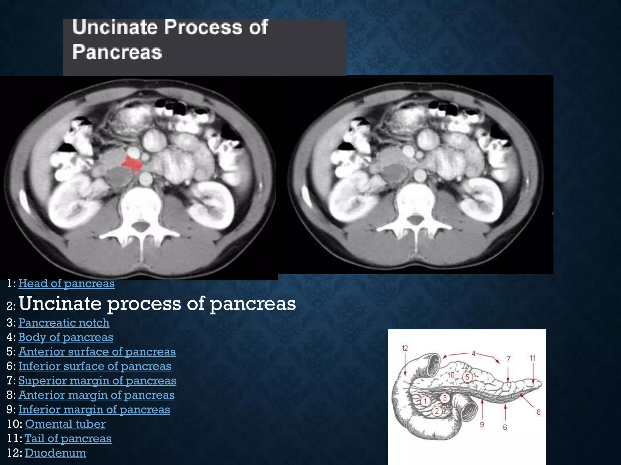 1: Head of pancreas
2: Uncinate process of pancreas
3: Pancreatic notch
4: Body of pancreas
5: Anterior surface of pancreas
6: Inferior surface of pancreas
7: Superior margin of pancreas
8: Anterior margin of pancreas
9: Inferior margin of pancreas
10: Omental tuber
11:Tail of pancreas
12: Duodenum
 