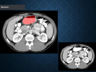 Tutorial Abdominal CT scan test.pdf