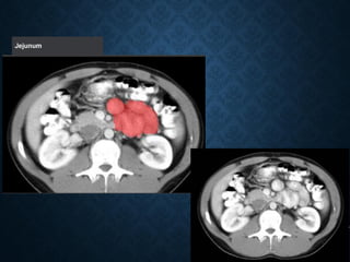 Tutorial Abdominal CT scan test.pdf