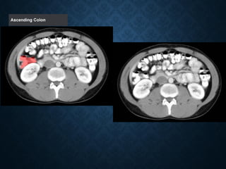 Tutorial Abdominal CT scan test.pdf