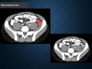 Tutorial Abdominal CT scan test.pdf